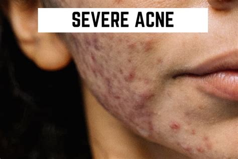 Close-up of severe acne lesion