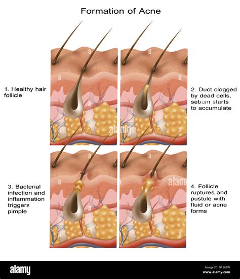 Close-up illustration of clogged hair follicle leading to acne