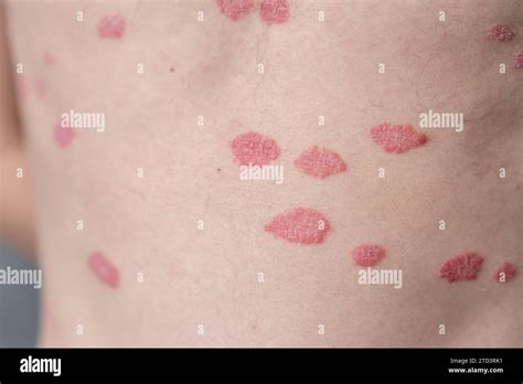 Image showing typical red, scaly patches of psoriasis on skin