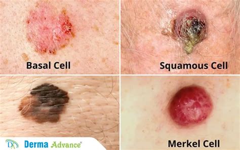 Diagram illustrating different types of skin cancer (basal cell, squamous cell, melanoma)
