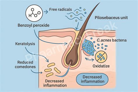 Infographic illustrating the dual action of benzoyl peroxide: killing bacteria and reducing inflammation.