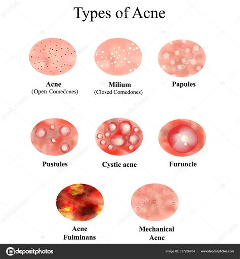 Illustration of different types of acne lesions: comedones, papules, pustules, nodules, and cysts.