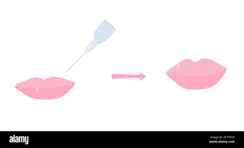 Close-up illustration showing the injection of hyaluronic acid into the lips.