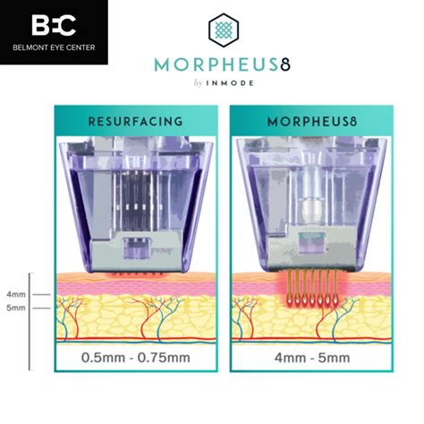 Diagram illustrating the Morpheus8 device with microneedles penetrating the skin to deliver RF energy.