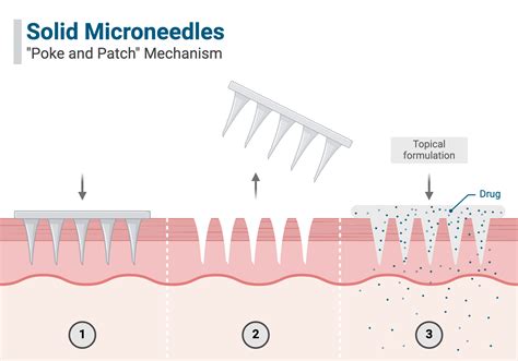 Close-up illustration of microneedles creating micro-injuries in the skin, with heat waves indicating RF energy penetration.