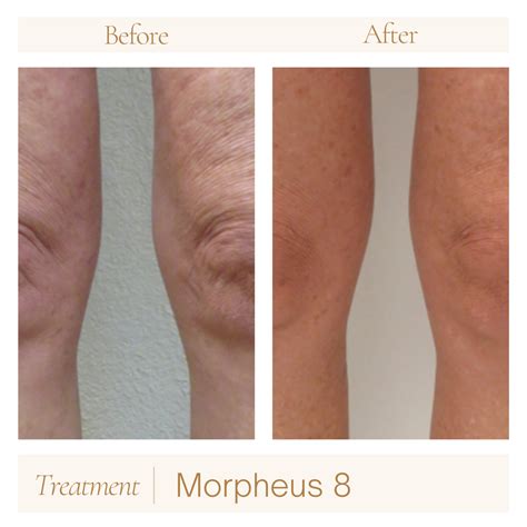 Collage of Morpheus8 before and after photos showing significant reduction in thigh cellulite and skin laxity.