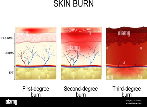 Illustration showing the layers of skin affected by first, second, and third-degree burns.