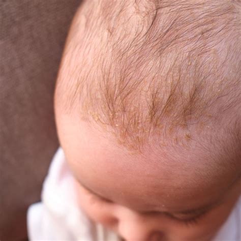 Split image showing typical cradle cap scales on a baby and mild white flakes on a toddler's shoulder.