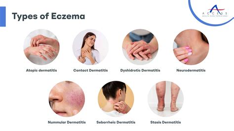 Infographic illustrating different types of eczema and their typical appearance on the ear.