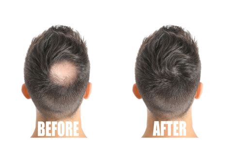 Infographic illustrating the benefits of microneedling for hair growth.