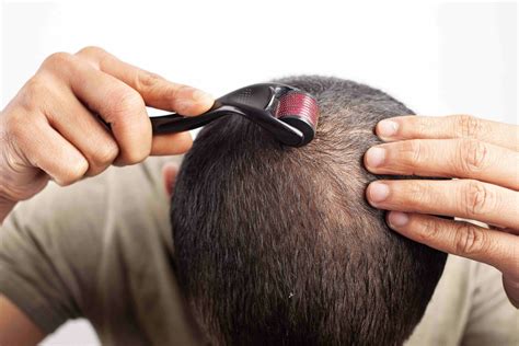 Diagram showing the correct directions for rolling a dermaroller on the scalp.
