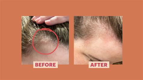 Before and after images of a scalp showing reduced buildup and healthier appearance.