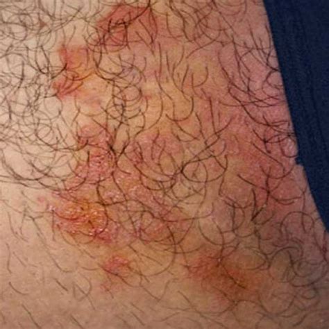 Illustration of the human groin area showing a red, itchy rash characteristic of jock itch.