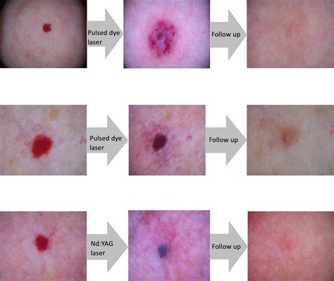 Diagram illustrating how laser treatment targets and eliminates blood vessels in cherry angiomas.