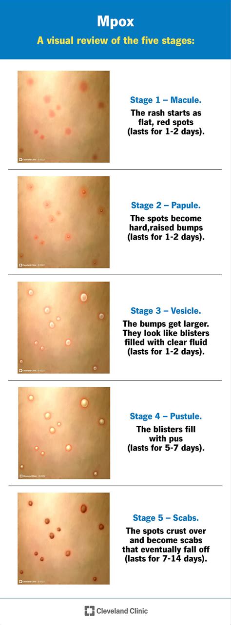 Infographic detailing the progression of mpox rash stages