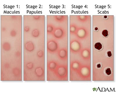 Close-up images of macules and papules stages of an mpox rash