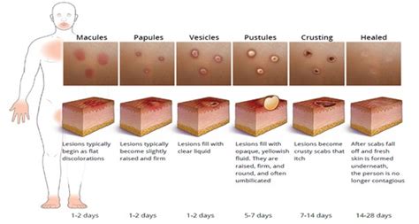 Diagram showing the evolution from vesicles to pustules and scabs in mpox lesions