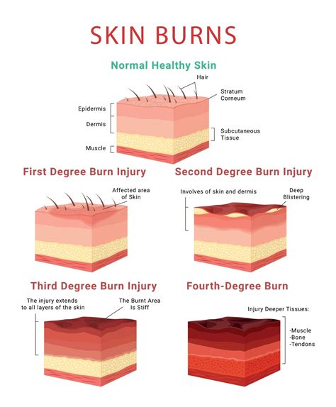 Diagram illustrating the three degrees of skin damage in road rash injuries.