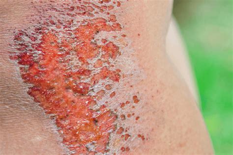 Close-up photo of a severe road rash injury on a leg.