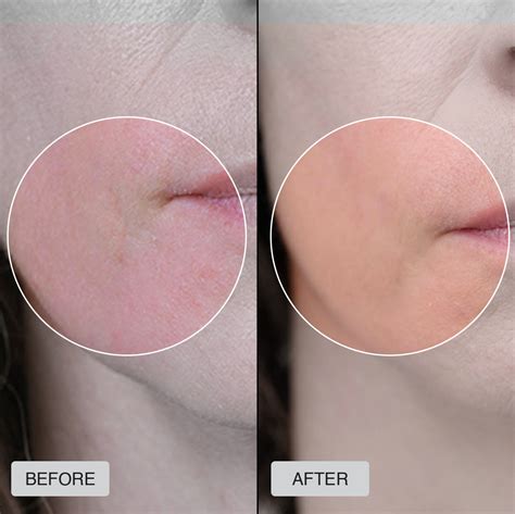 A split image showing a before and after of skin, with the 'before' showing redness and breakouts, and the 'after' showing a clearer, smoother complexion.