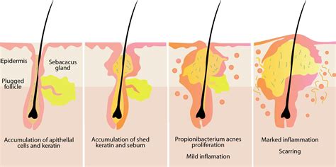 Infographic illustrating the formation of a sebum plug within a hair follicle.
