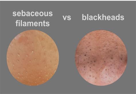 Side-by-side comparison of a blackhead and sebaceous filaments, highlighting visual differences.