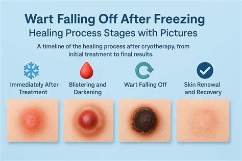 Illustration showing the healing process of a treated wart, from blister formation to complete skin recovery.