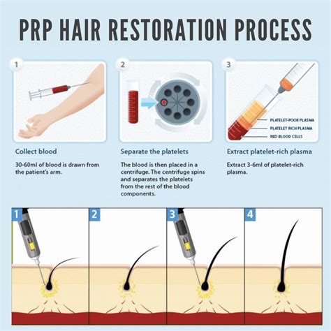 Diagram showing the process of PRP preparation and injection for hair restoration