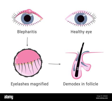 Illustration showing the anatomy of the eyelid and eyelash follicles, highlighting the affected areas in blepharitis.
