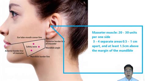 Diagram showing injection points for Botox in the masseter muscles for TMJ relief.