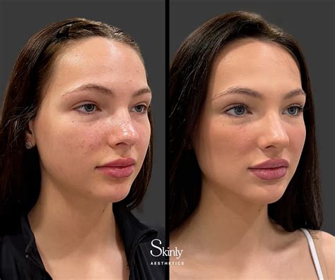Collage of anonymized before-and-after photos showcasing jawline slimming results from masseter Botox.