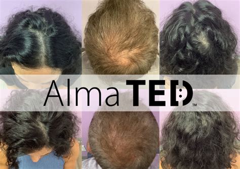 Diagram illustrating the process of TED hair restoration compared to traditional PRP injections.