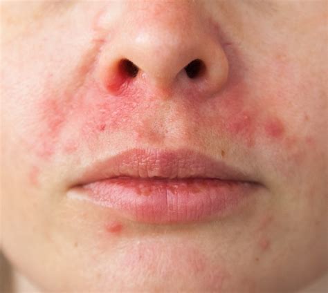 Close-up image showing the characteristic red bumps and rash of perioral dermatitis around the mouth and nose.