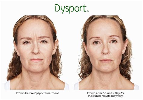 A before and after comparison of Dysport treatment for frown lines, showcasing a smoother forehead and brow area.