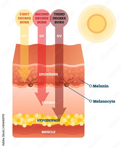 Illustration showing the layers of skin affected by sunburn.