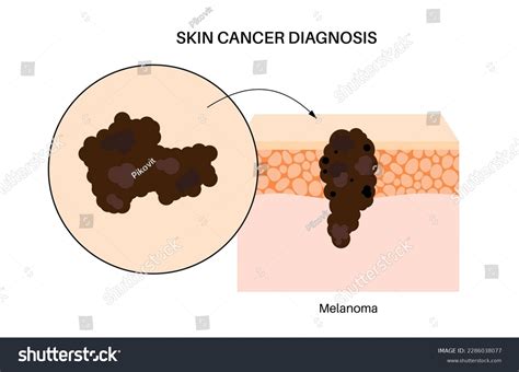 Anatomical illustration showing common locations of skin cancer development on the body, highlighting both sun-exposed and non-sun-exposed areas.