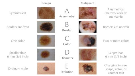 Visual comparison of a normal mole and a melanoma, illustrating the ABCDE criteria.