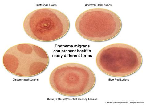 Illustration of a bull's-eye rash, characteristic of Lyme disease.