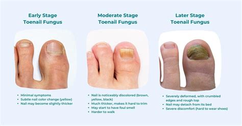 Collage of images showing different symptoms of nail fungus: discolored nails, thickened nails, and nails lifting from the nail bed.