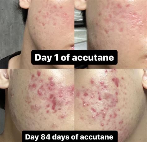 timeline graphic showing the typical duration of an Accutane purge