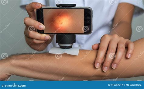 Close-up of a dermatologist examining a mole on a patient's arm using a dermatoscope.