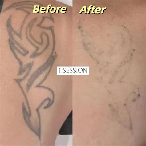 Before and after comparison photos showing the reduction of a hand tattoo after Pico Laser treatment.