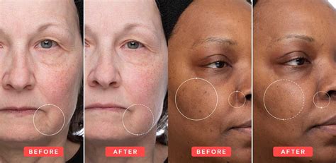 Before and after images showcasing improvements in skin texture and dark spots after using the serum.