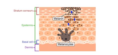 Diagram illustrating the layers of skin and how a chemical peel targets melanin in the epidermis to reduce freckles.