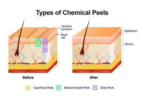 Infographic comparing superficial, medium, and deep chemical peels, highlighting their depth, primary acids, best uses, and typical downtime.