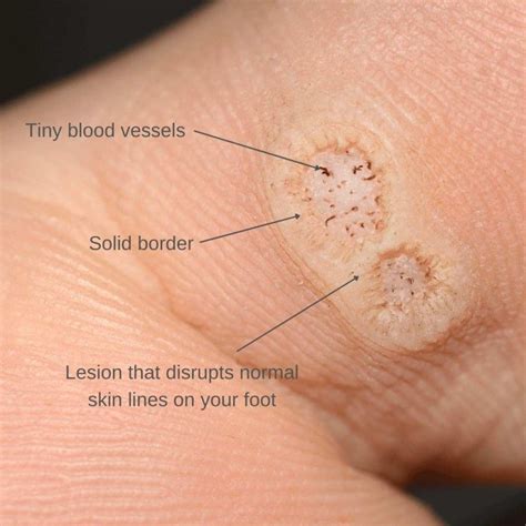 Illustration of a hand with common warts on the fingers and a plantar wart on the sole of the foot.