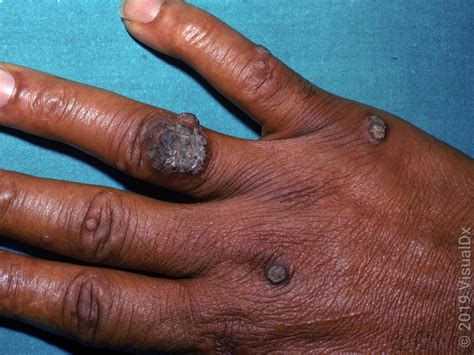 Close-up photograph of a common wart on a finger, showing its rough, cauliflower-like texture and dark dots.