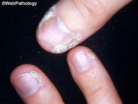 Image showing periungual warts developing around a fingernail.