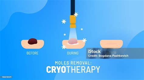 Diagram illustrating the process of cryotherapy for wart removal.