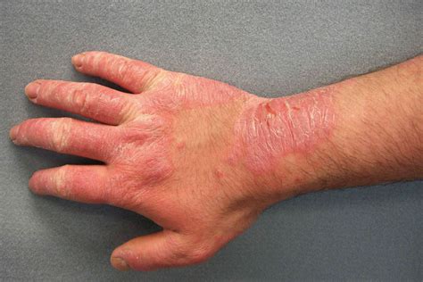 Image depicting redness, scaling, crusting, and swelling characteristic of allergic contact dermatitis.